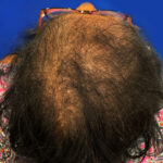 Hair transplant for women