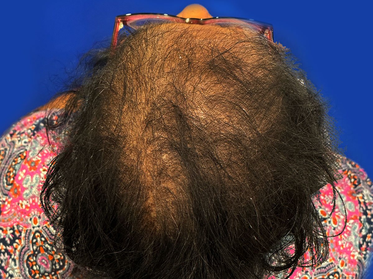 Hair transplant for women